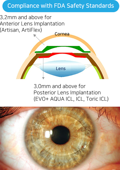 icl lens insertion price inspection all