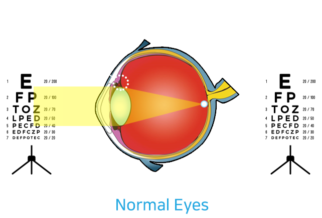 The items to check the price of presbyopia surgery in Gangnam are: