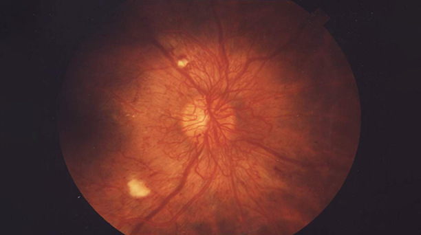 당뇨망막병증 이미지