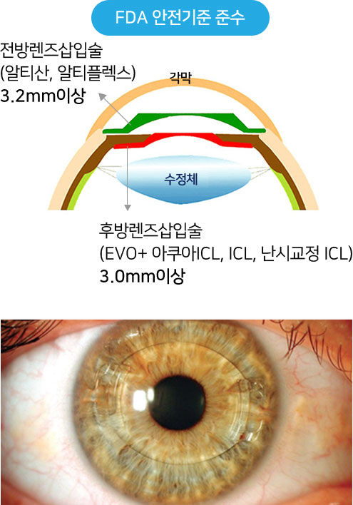 전방렌즈 삽입수술 안정적인 수술예 전방렌즈(3.2mm 이상)