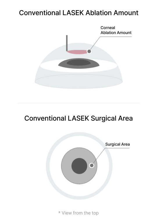 Conventional LASEK(Custom-Fit LASEK)