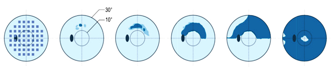 녹내장 진행에 따른 시야 변화과정